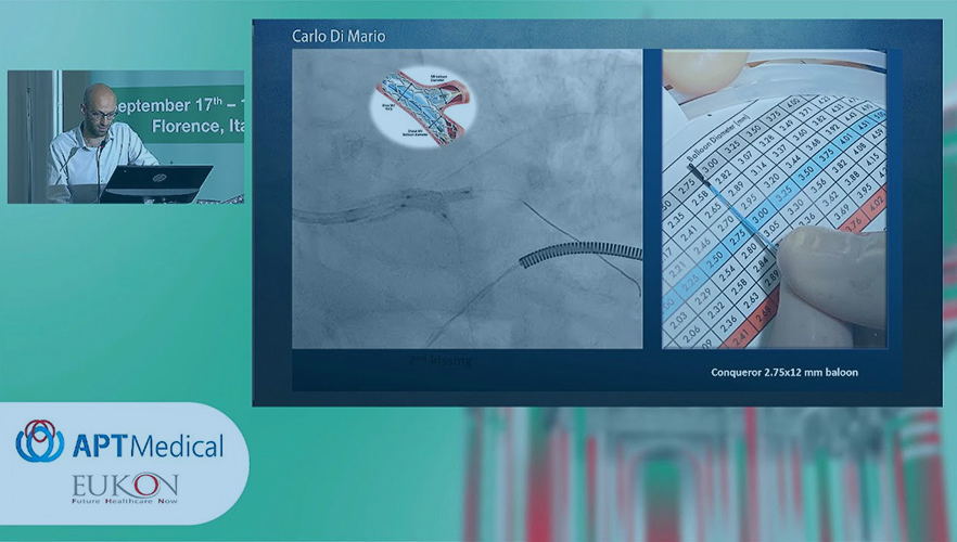 Beyond Extreme Tortuosity to Reduce Ischemic Burden - EuroCTO/GISE 2021